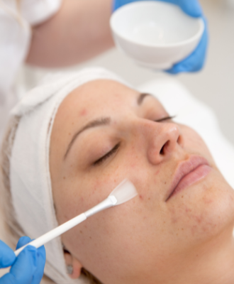 Woman having skin peel treatment