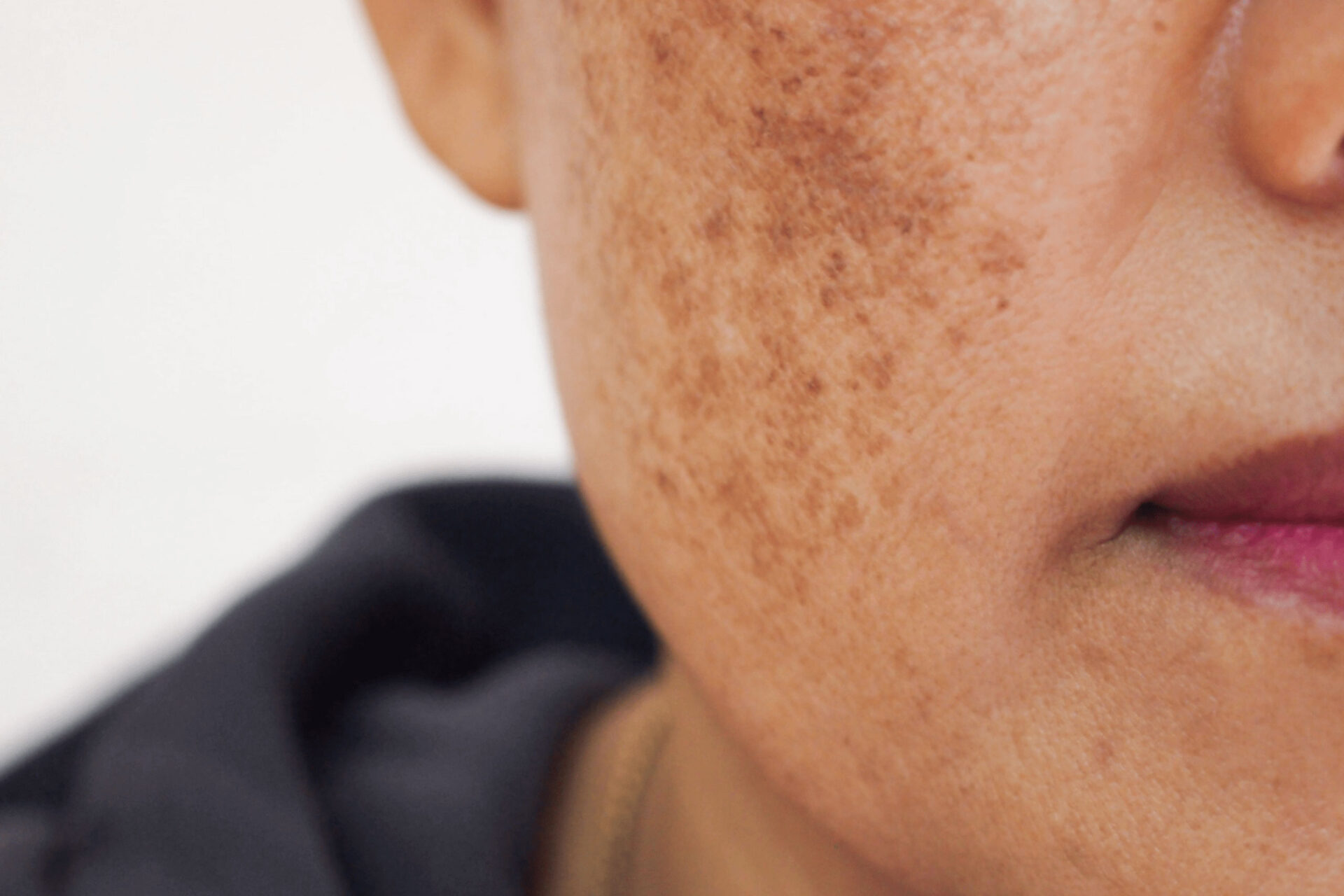 zoomed in face highlighting pigmentation