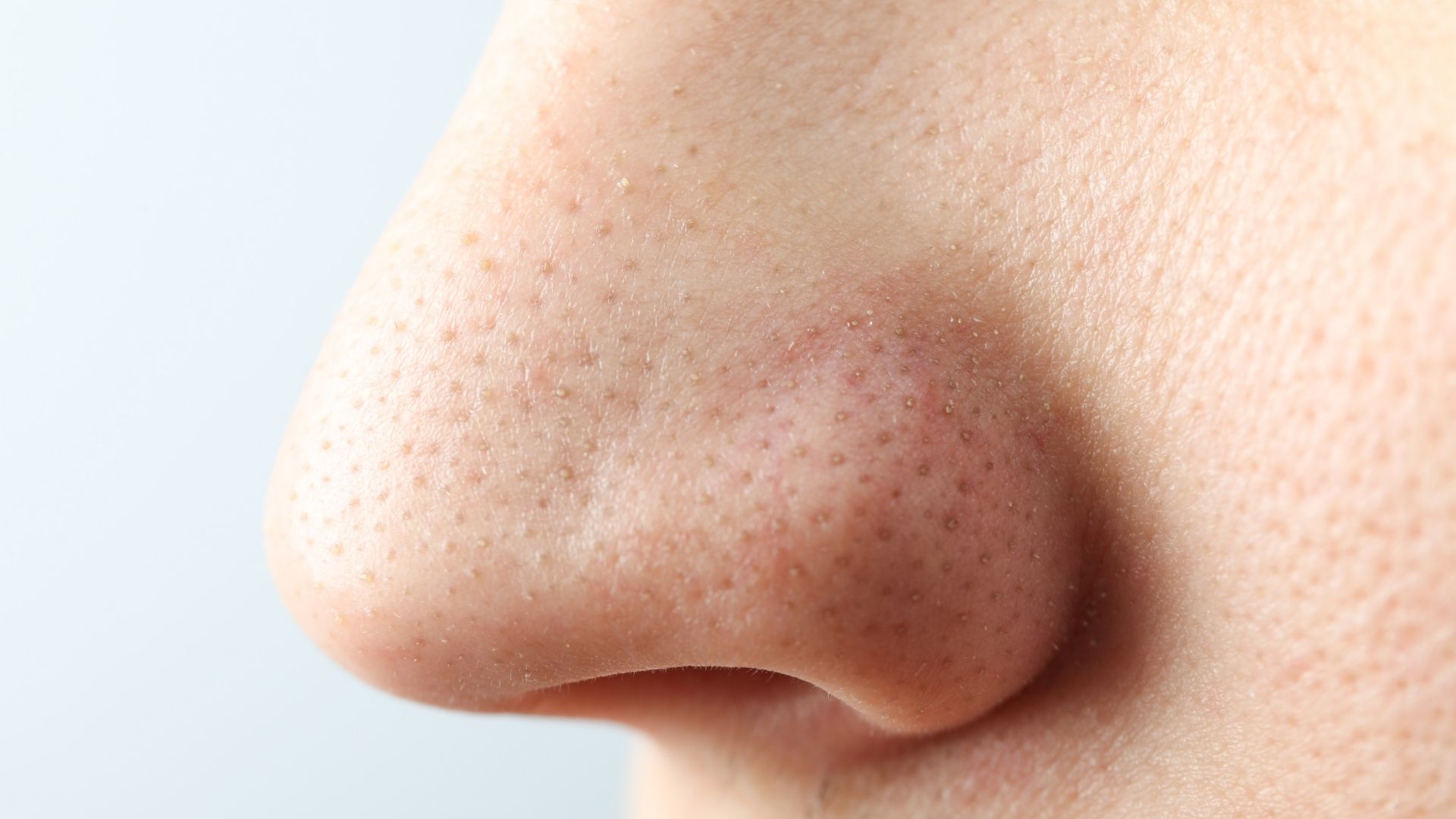 Zoomed in to nose highlighting pores